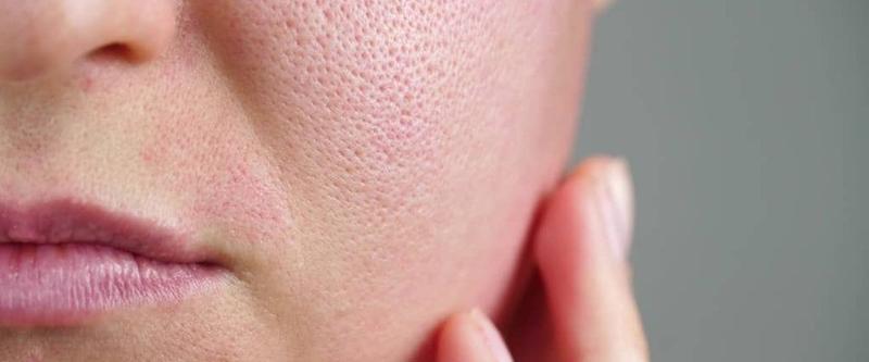 Jak dbać o cerę tłustą, aby cieszyć się zdrowym i promiennym wyglądem?