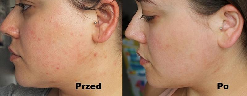 Odkryj tajemnice kwasu glikolowego i jego wpływ na piękną skórę