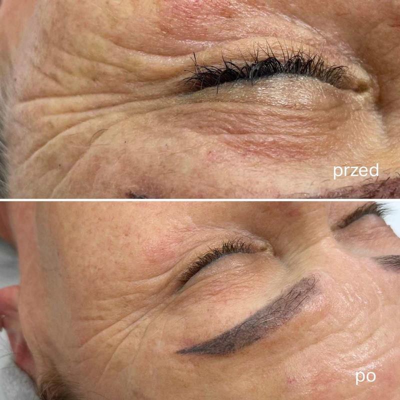 Biostymulacja i regeneracja skóry