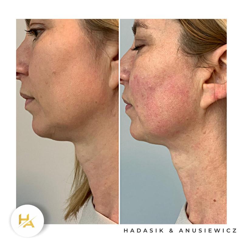 Opinie i efekty zabiegu ultraformer