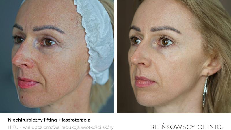 Przygotowanie do zabiegu ultraformera