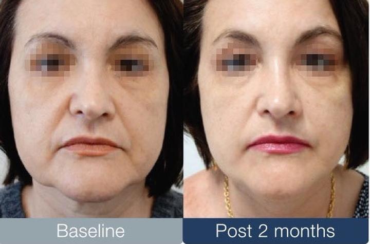 Redukcja tkanki tłuszczowej bez skalpela