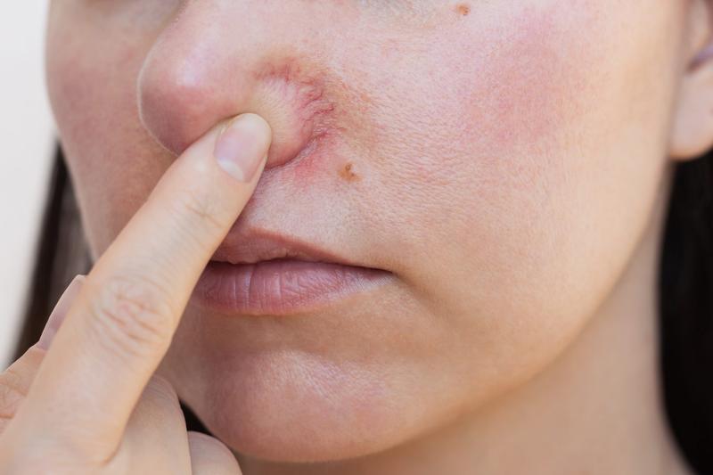 Składniki aktywne na naczynka