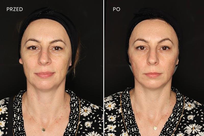 Stymulatory tkankowe – nowa era w walce ze starzejącą się skórą